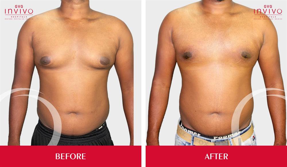 Gynecomastia Grade 1 Before After