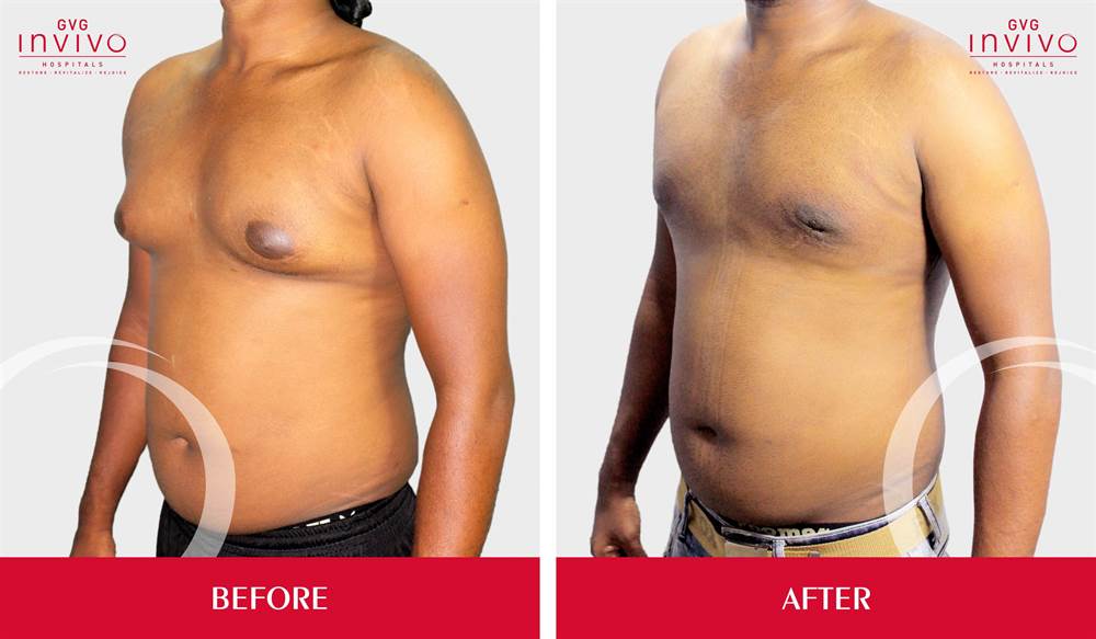 Gynecomastia Grade 2 Before After