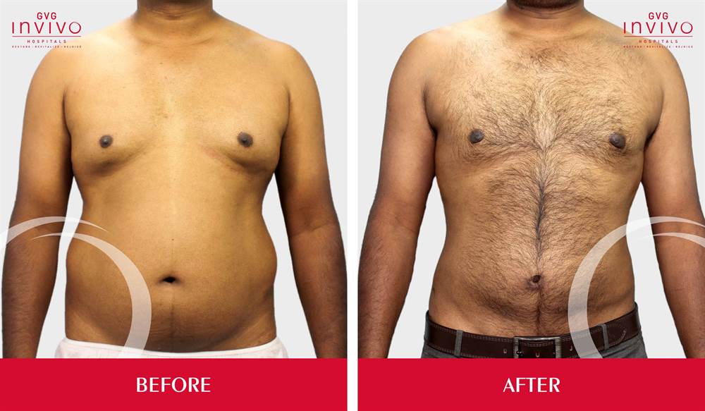 Gynecomastia Grade 2 Before After Side View