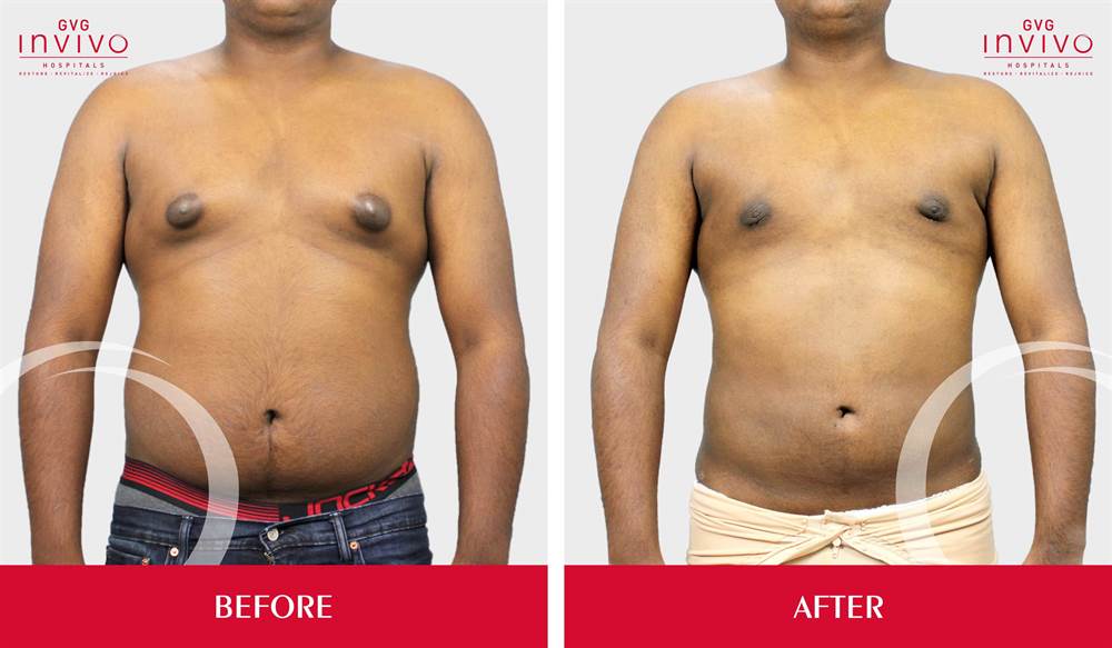 Gynecomastia Severe Before After