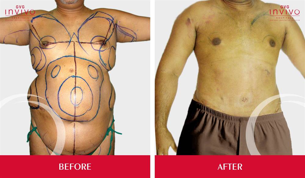Gynecomastia Surgery Result