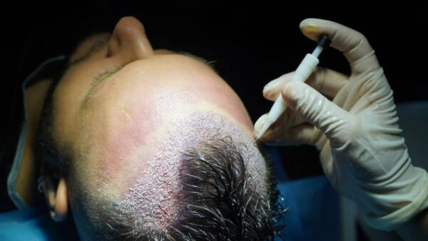 DHI - Direct Hair Implantation using Choi pen-like implanter at Invivo Hospitals