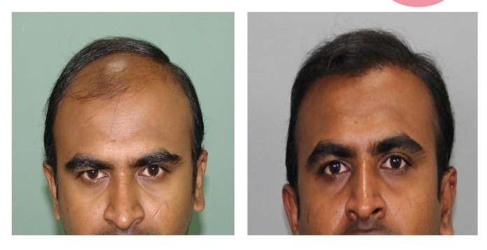 Hairline Hair Transplant Before and After Result at Invivo Hospitals