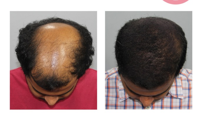 Crown Area Hair Transplant Before and After Result at Invivo Hospitals