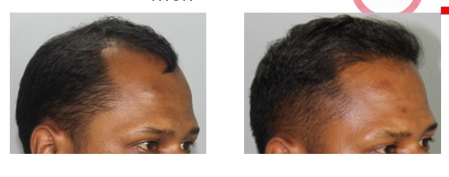 FUE Hair Transplant Before and After Result at Invivo Hospitals