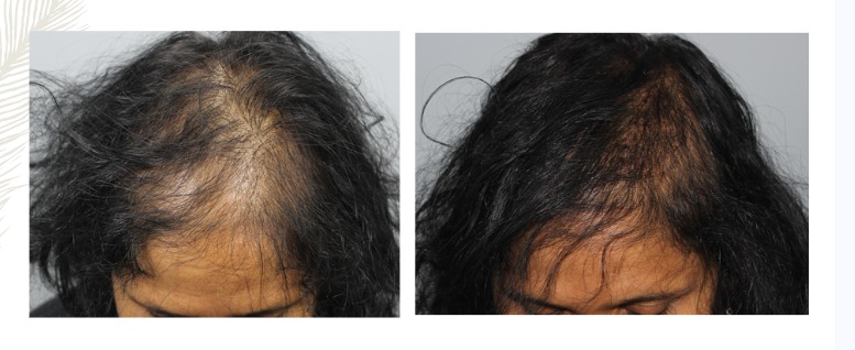 Long Hair Transplant Before and After Result at Invivo Hospitals