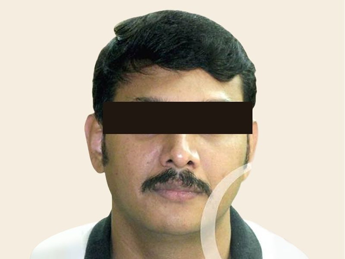 Rhinoplasty After Result at GVG Invivo Hospitals