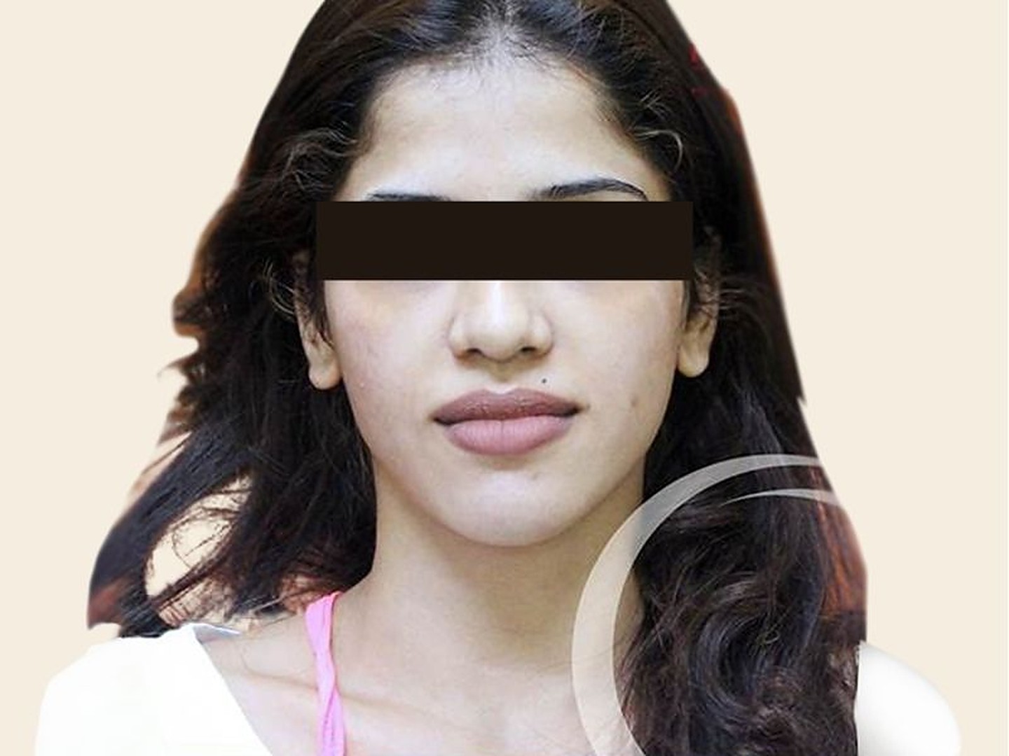 Rhinoplasty After Result at GVG Invivo Hospitals