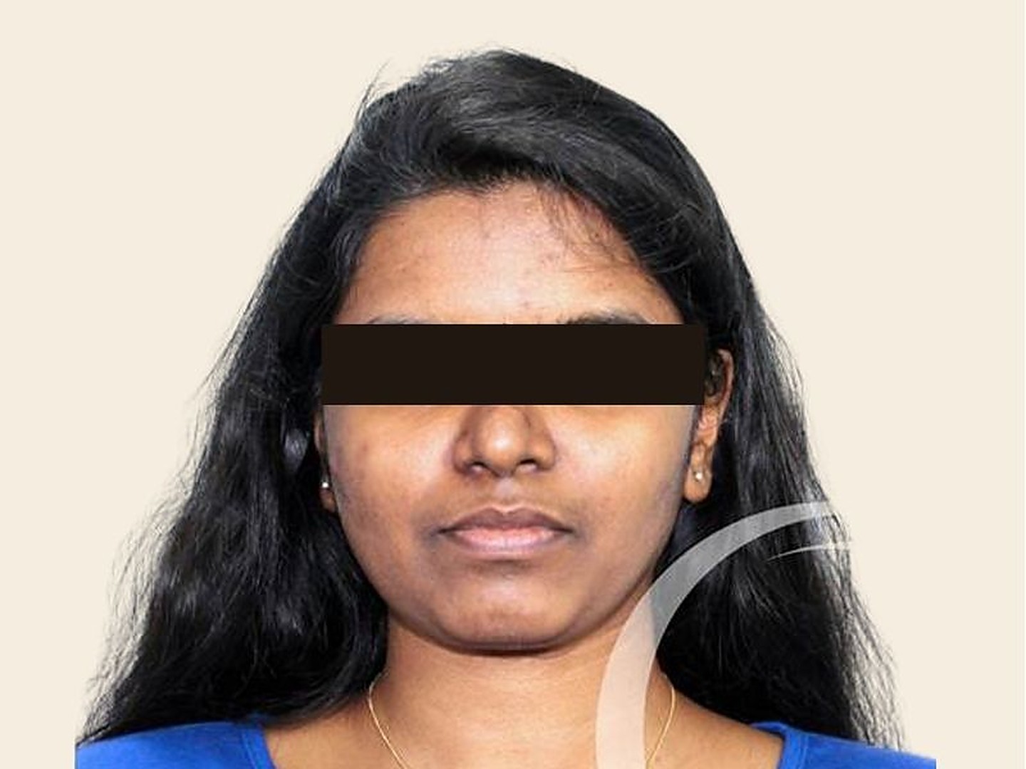 Rhinoplasty After Result at GVG Invivo Hospitals