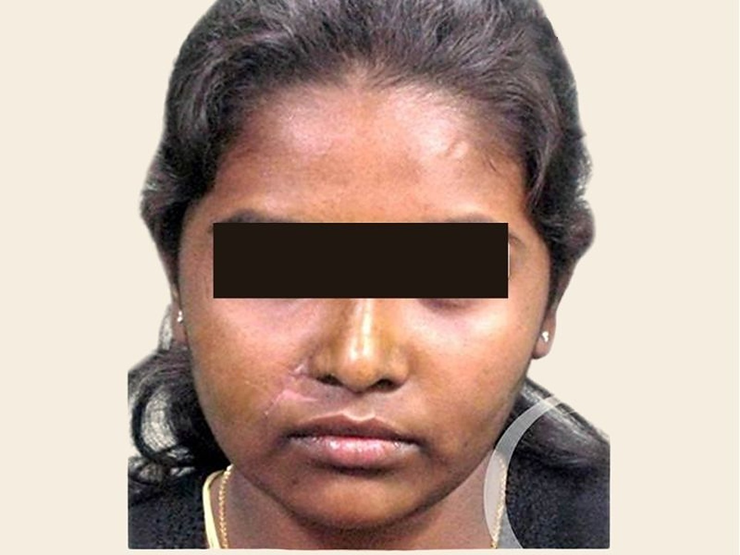 Rhinoplasty After Result at GVG Invivo Hospitals