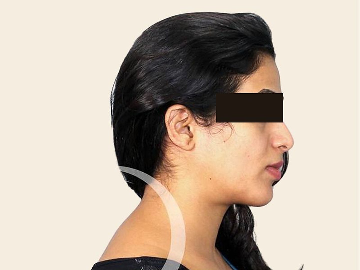 Rhinoplasty After Result at GVG Invivo Hospitals
