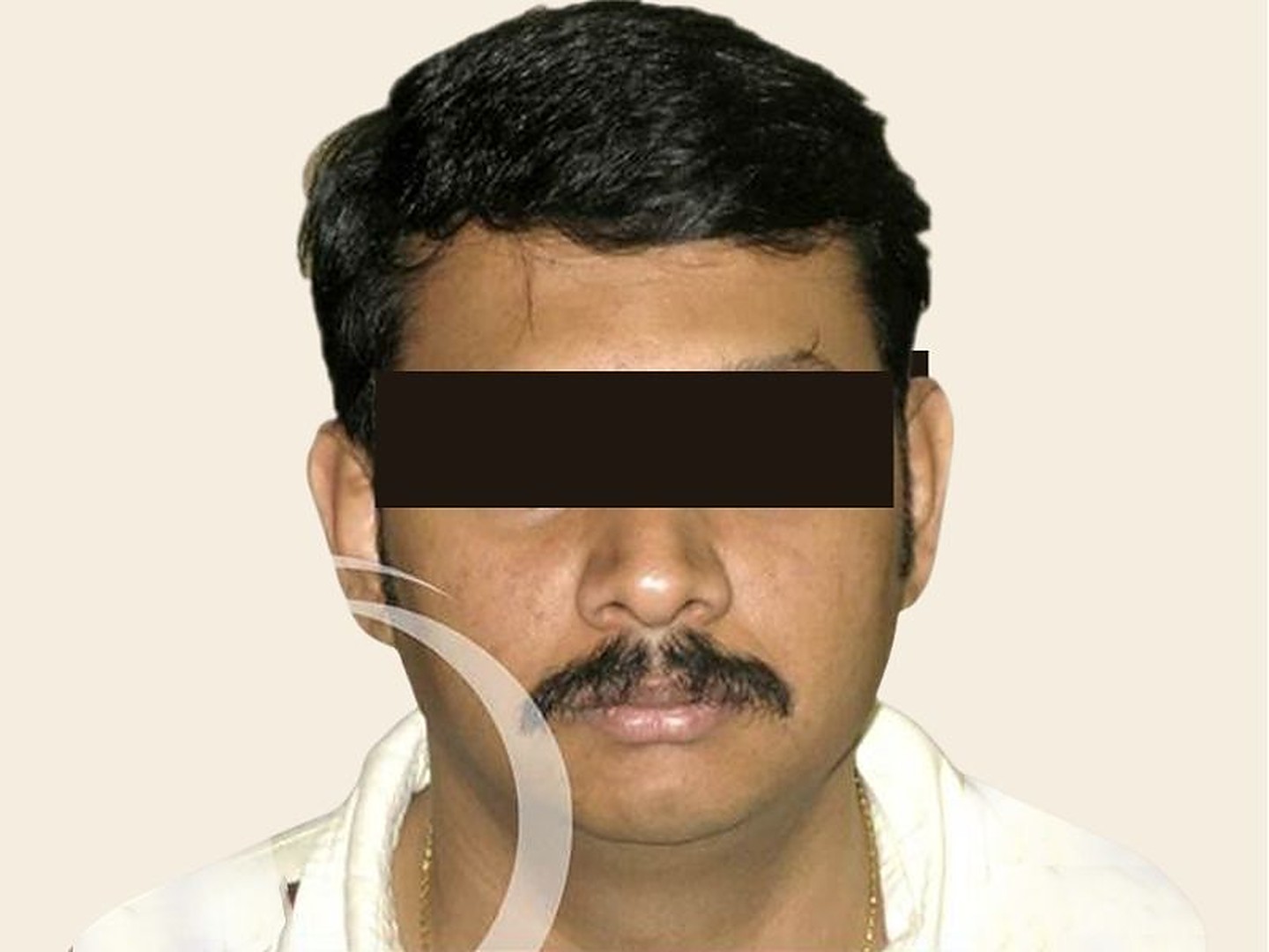 Rhinoplasty Before Result at GVG Invivo Hospitals