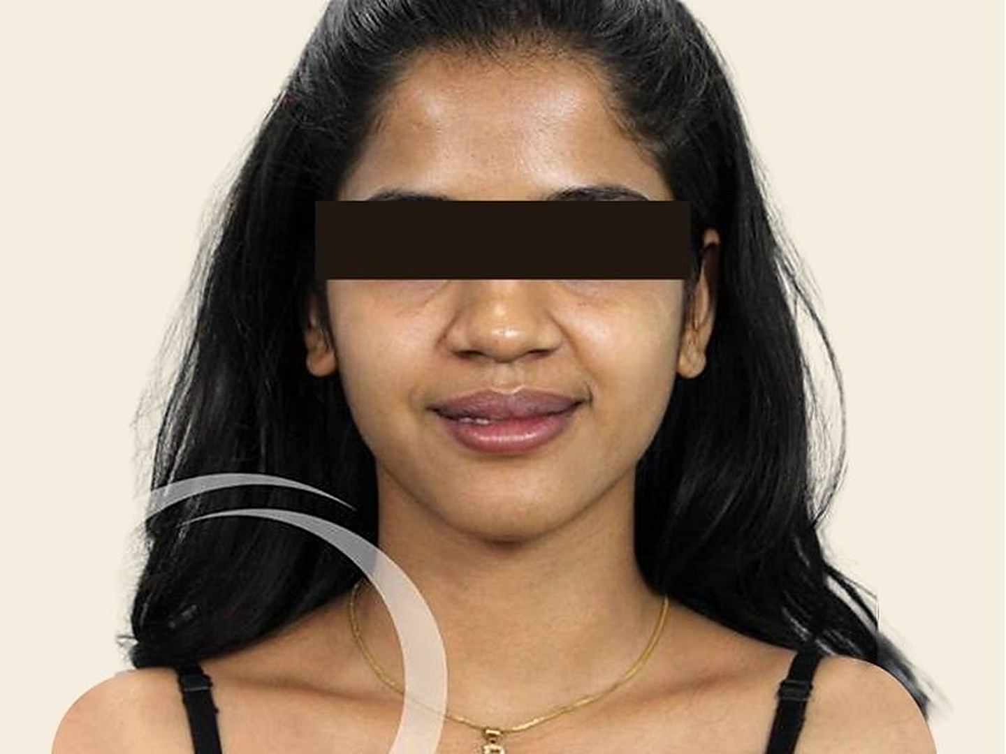 Rhinoplasty Before Result at GVG Invivo Hospitals