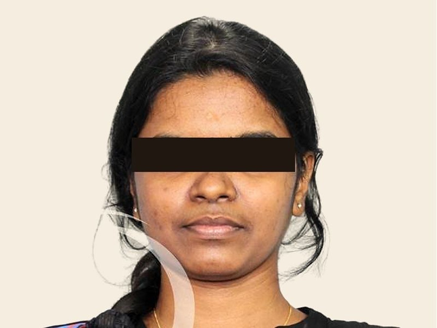 Rhinoplasty Before Result at GVG Invivo Hospitals