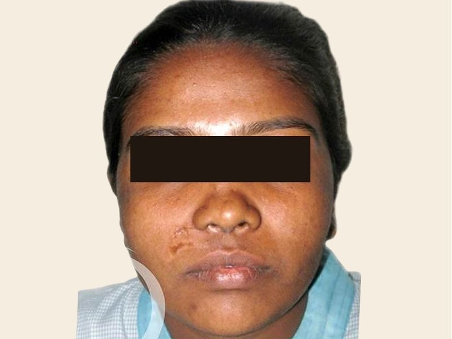 Rhinoplasty Before Result at GVG Invivo Hospitals