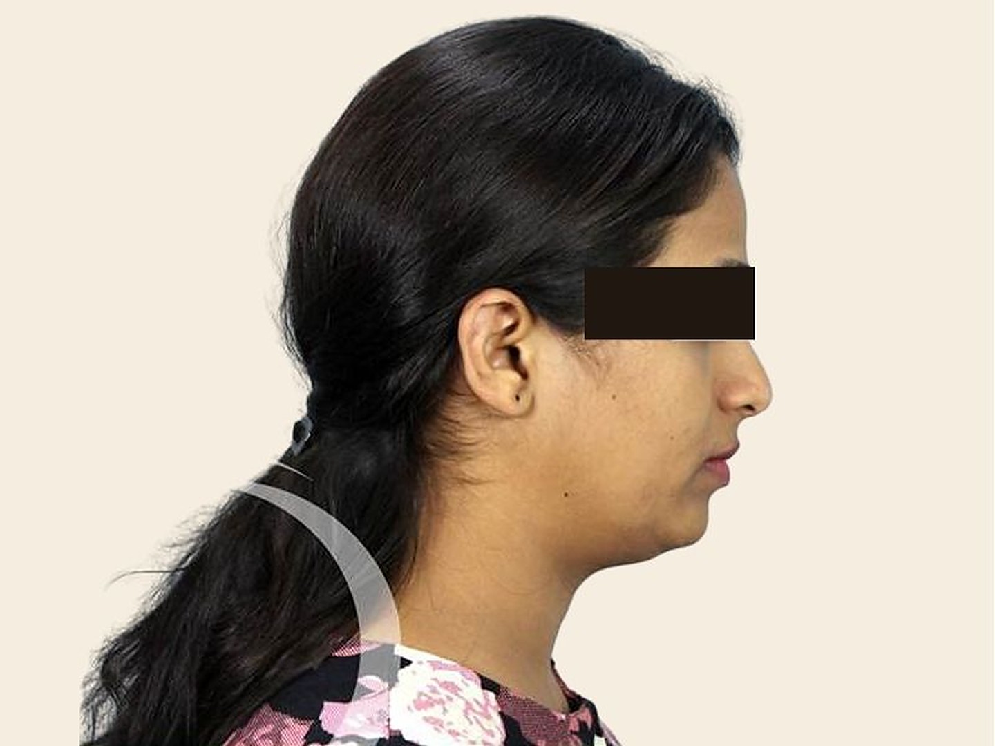 Rhinoplasty Before Result at GVG Invivo Hospitals